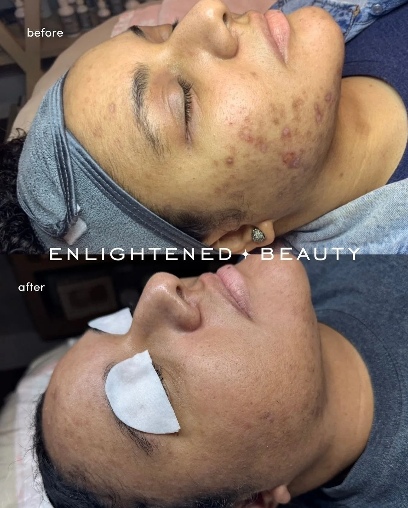 &ldquo;Morgan, I know you treat acne, but do you have any before and afters of pigmentation? PIH OR PIE?&rdquo;

Me: 🪄 

** for those of you who have been thinking about booking with us, but may not suffer with acne just know that whatever your skin
