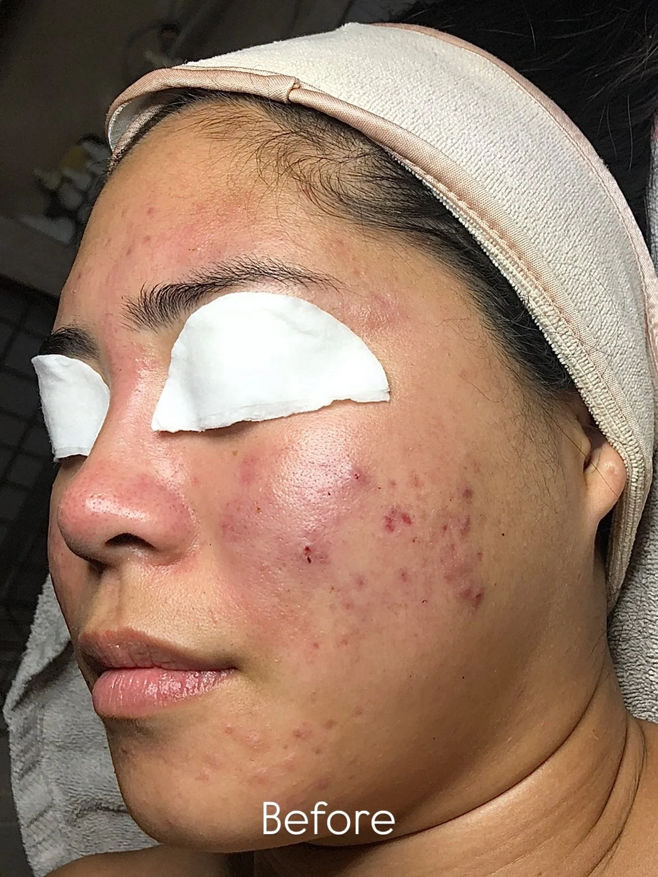 When I say it&rsquo;s peel 🐍 szn, this is what I mean 💁🏻&zwj;♀️✨

Subscribe to exclusive content on Instagram if you want me to be your father figure 😜 🪄 

📍 Enlightened Beauty
Sacramento + Granite Bay CA
📱 916 365 7958
💻  EnlightenedBeautySa