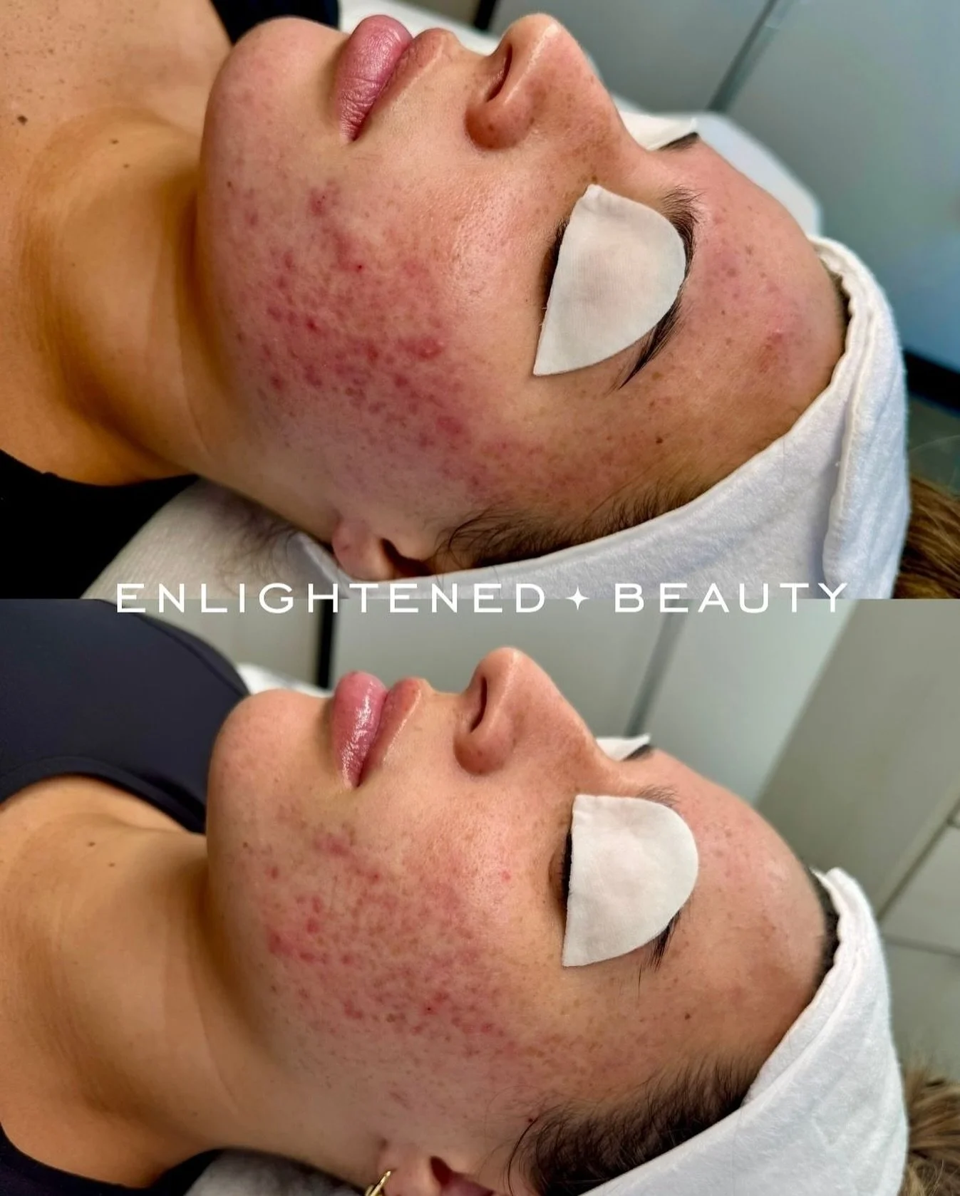✨ It&rsquo;s officially Peel Season ✨

This is the power of just one chemical peel performed by a licensed advanced specialist. 🍂

What you&rsquo;re seeing here is not magic&hellip;it&rsquo;s cellular science in action.

Chemical peels work by disso