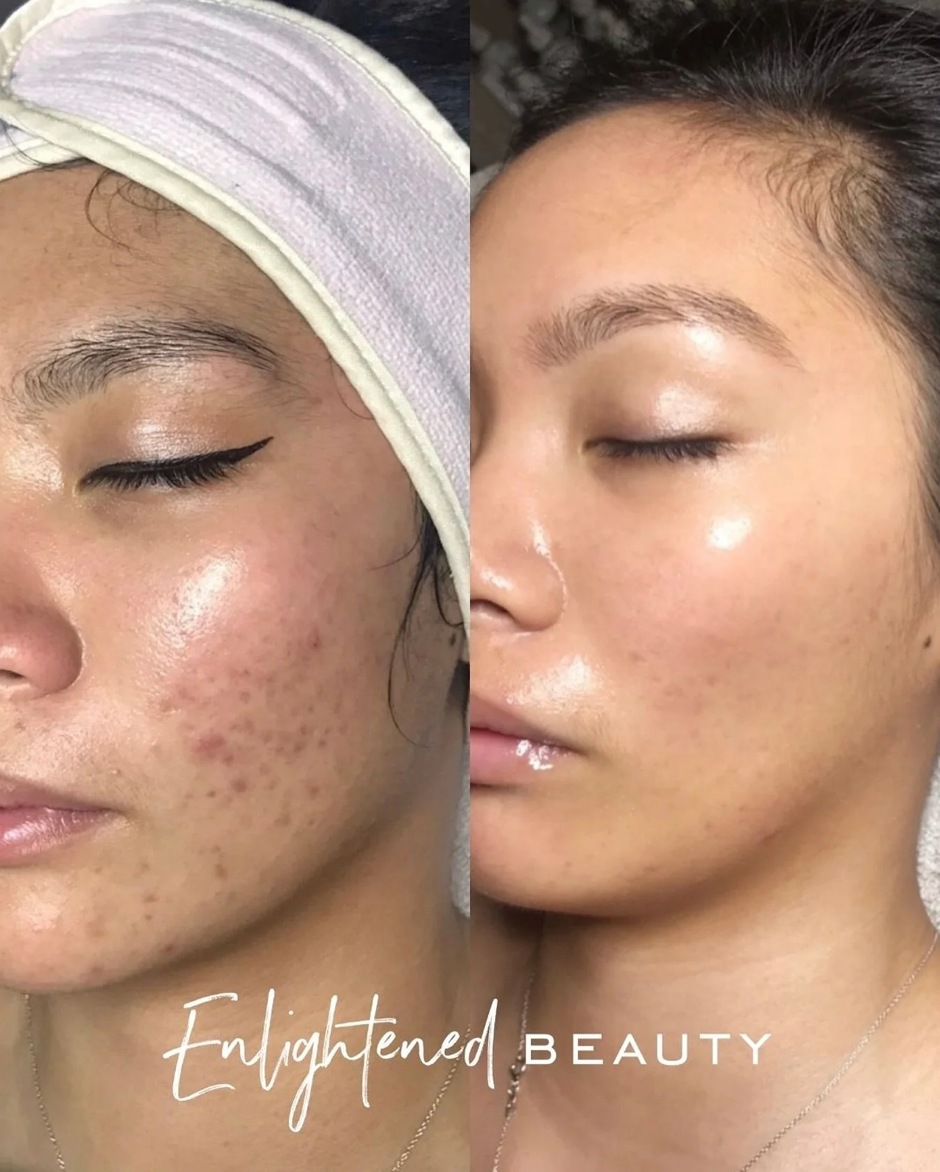 If your skin looks like the before, this is your sign to start your healing journey today.

💫 Where to Start:

1️⃣ Schedule a Consultation. We&rsquo;ll discuss your skin goals, current products, and lifestyle.
2️⃣ Begin w/ a Hybrid Peel. A treatment