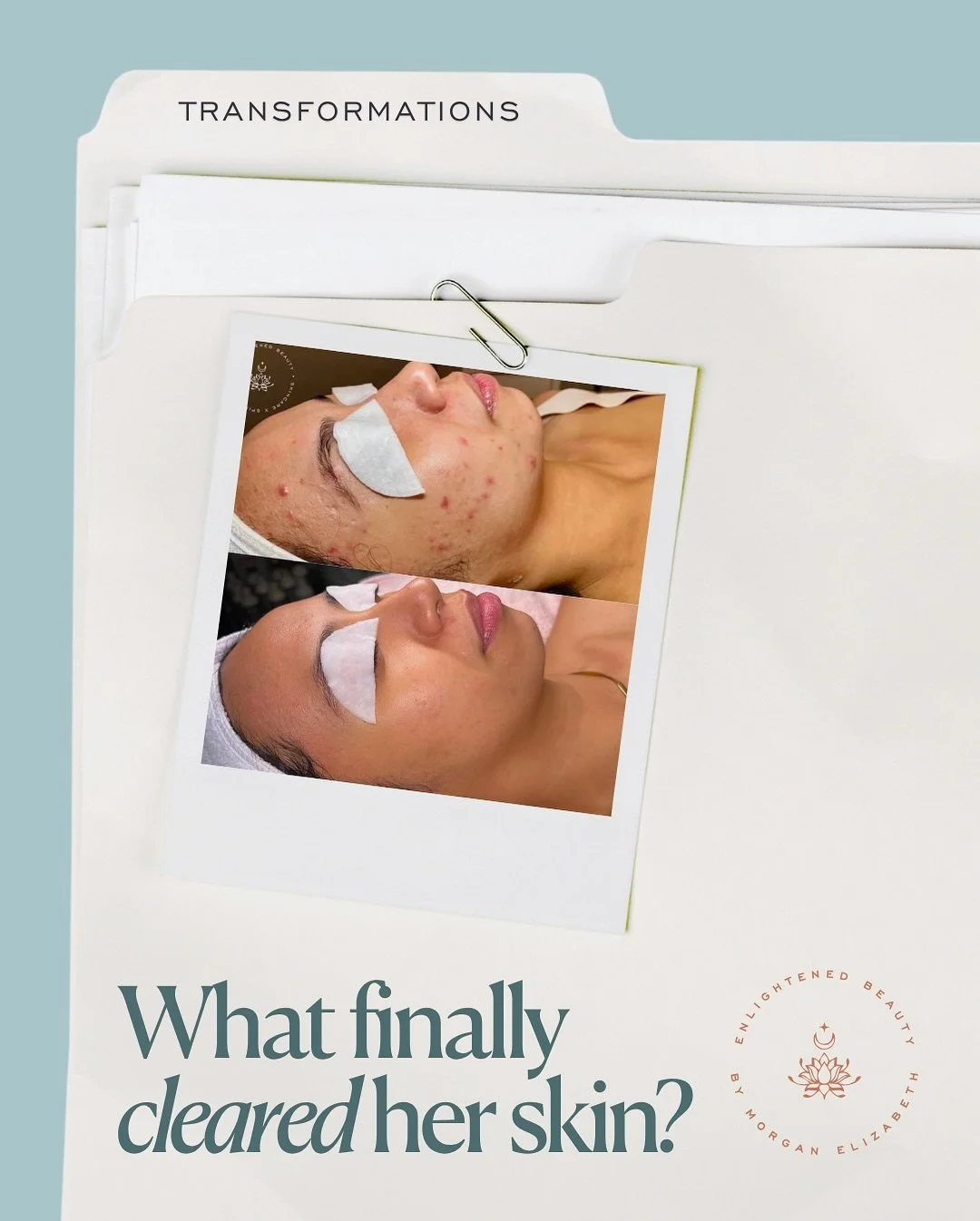 Hannah didn&rsquo;t just clear her skin.
She rebuilt her confidence.
⠀⠀⠀⠀⠀⠀⠀⠀⠀
Real routine.
Real consistency.
Real transformation.
⠀⠀⠀⠀⠀⠀⠀⠀⠀
Want her AM + PM regimen and our guide on what it really takes to transform your skin?
⠀⠀⠀⠀⠀⠀⠀⠀⠀
Comment &ld