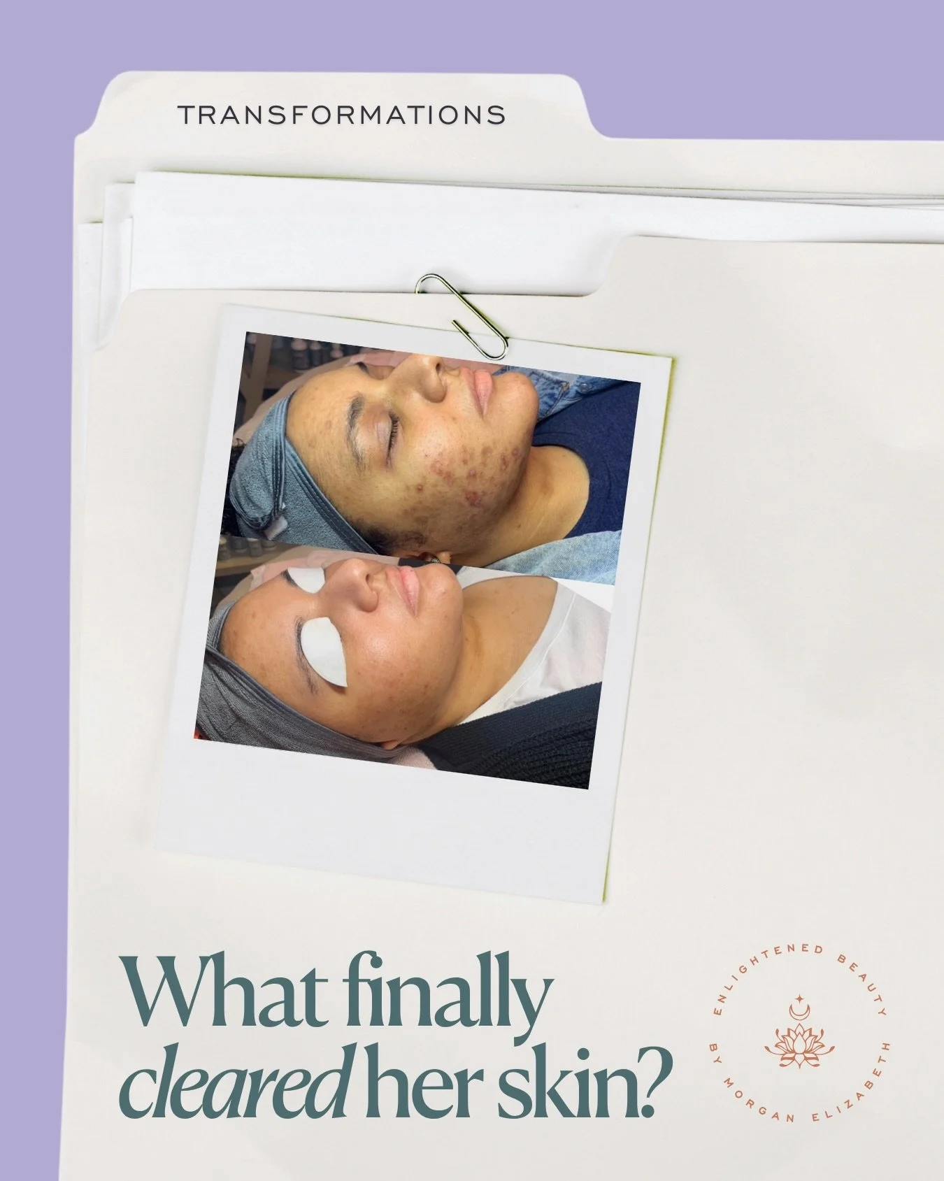 Amanda&rsquo;s results came from consistency, barrier repair, and the emotional work behind the scenes.
⠀⠀⠀⠀⠀⠀⠀⠀⠀
She didn&rsquo;t just brighten her skin...she brightened her whole energy. 
⠀⠀⠀⠀⠀⠀⠀⠀⠀
Now she has:
More calm.
More consistency.
A barrie