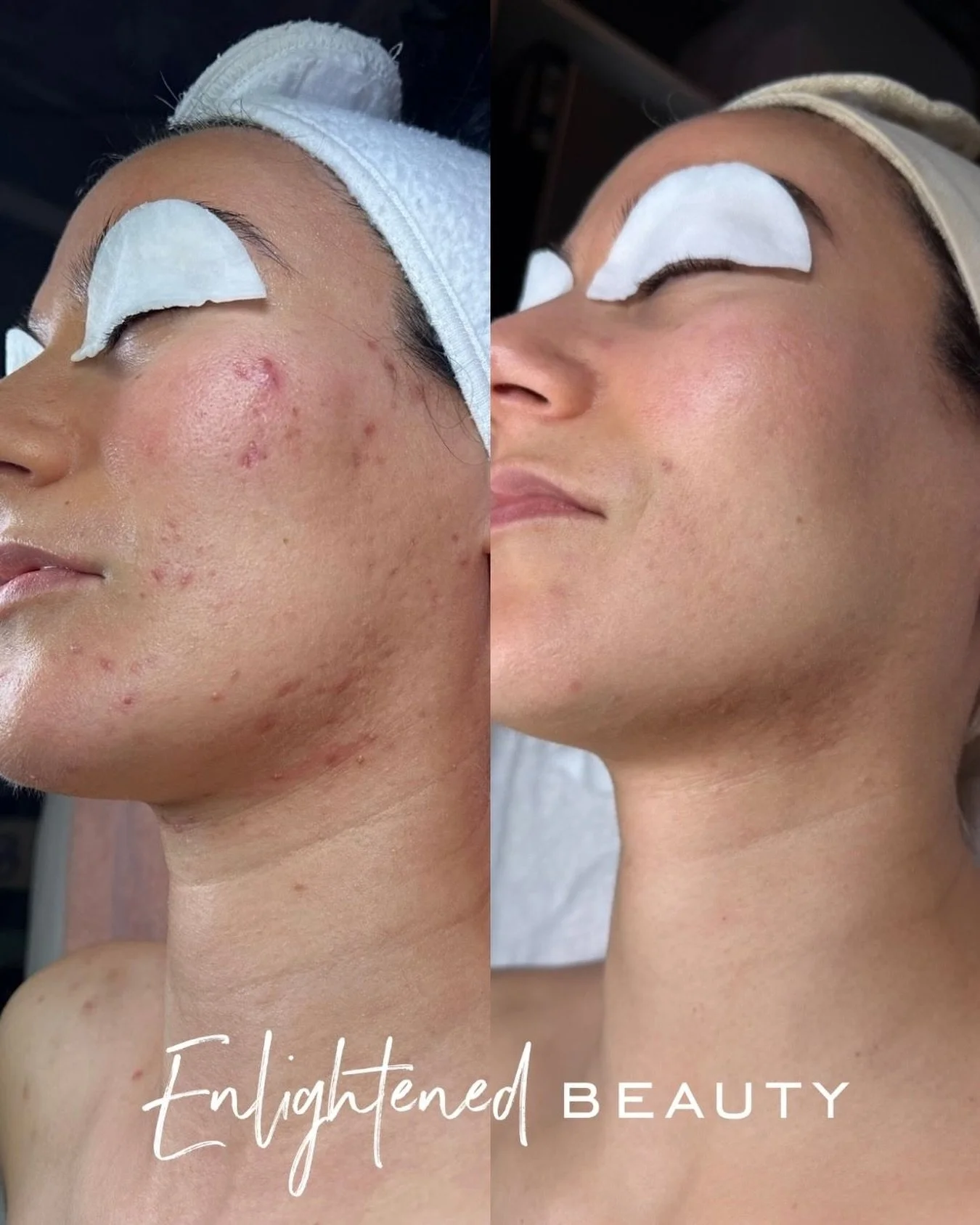 This didn&rsquo;t happen overnight.
And it definitely didn&rsquo;t happen by accident.

This is what happens when we stop chasing quick fixes and start treating the skin with patience, strategy, and respect. Barrier first. Inflammation down. Nervous 