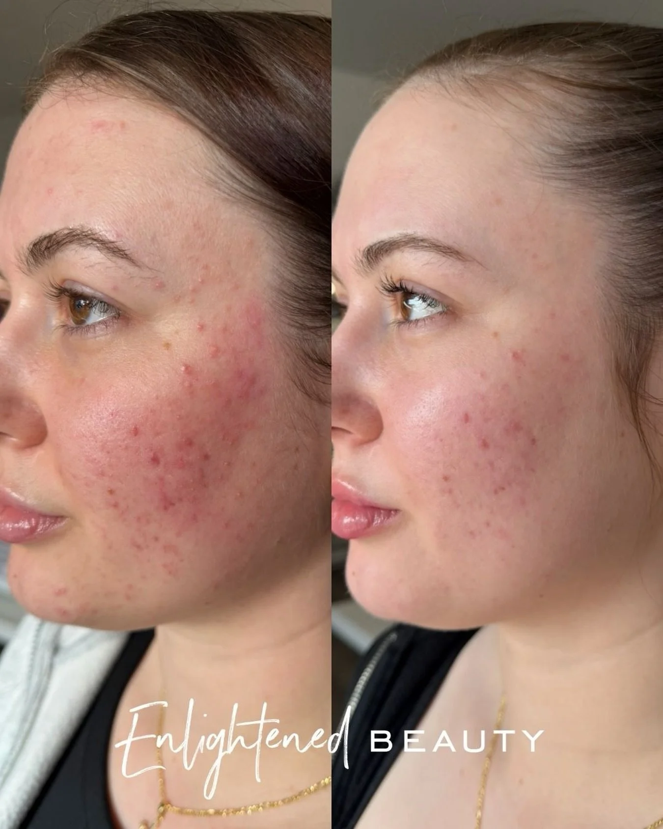 ✨ ONLY 14 DAYS APART ✨

When I say consistency + the right clinical homecare changes skin&hellip; this is exactly what I mean.

This client followed a complete Lira Clinical regimen&hellip; nothing aggressive, nothing overwhelming, just intentional, 