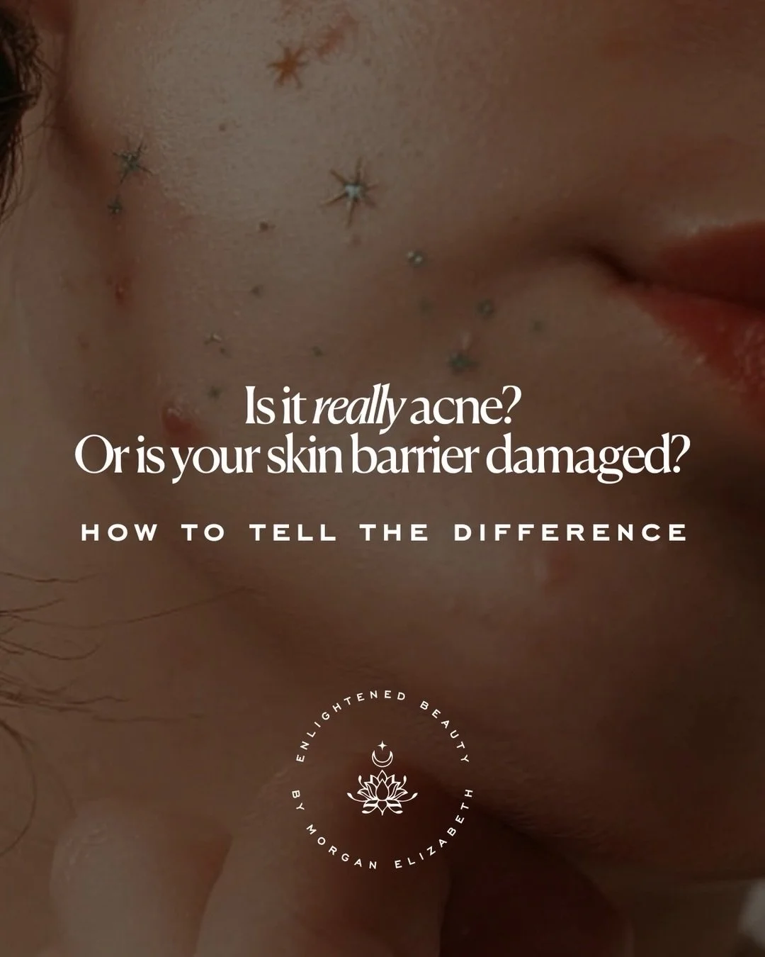 Have you ever considered that your &ldquo;acne&rdquo; might not actually be acne? ⬇️

One of the hardest things to hear as someone who&rsquo;s been fighting their skin is that the fight itself might be the problem. 

Sometimes acne is acne. Sometimes