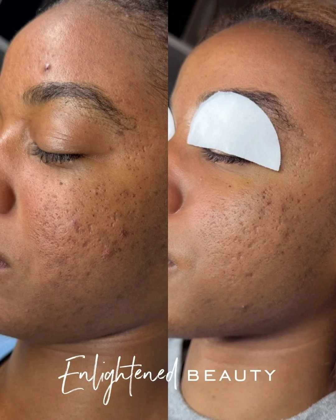 4 months 🤎

That is what intentional, corrective skincare can do when the plan is personalized and the client stays consistent.

When she first came to me, we were not just looking at breakouts. We were looking at inflammation, post inflammatory pig