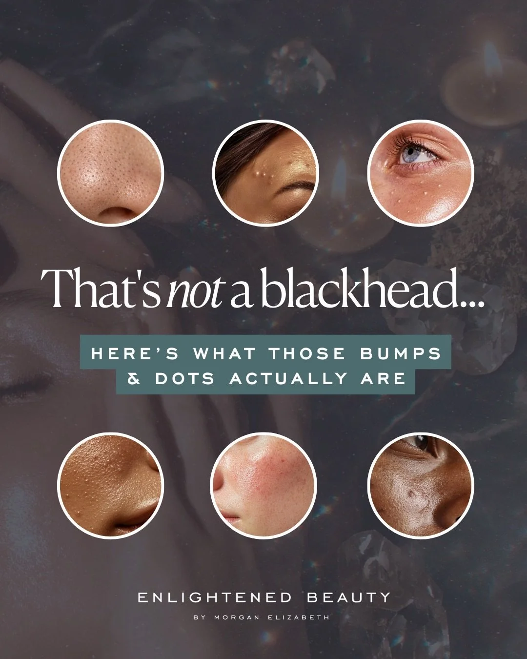 Your skin is not the problem, babe. Mistaking the concern is. ✨

So many of us are out here treating sebaceous filaments like blackheads, squeezing milia that literally cannot be squeezed, and throwing actives at closed comedones like more is more.

