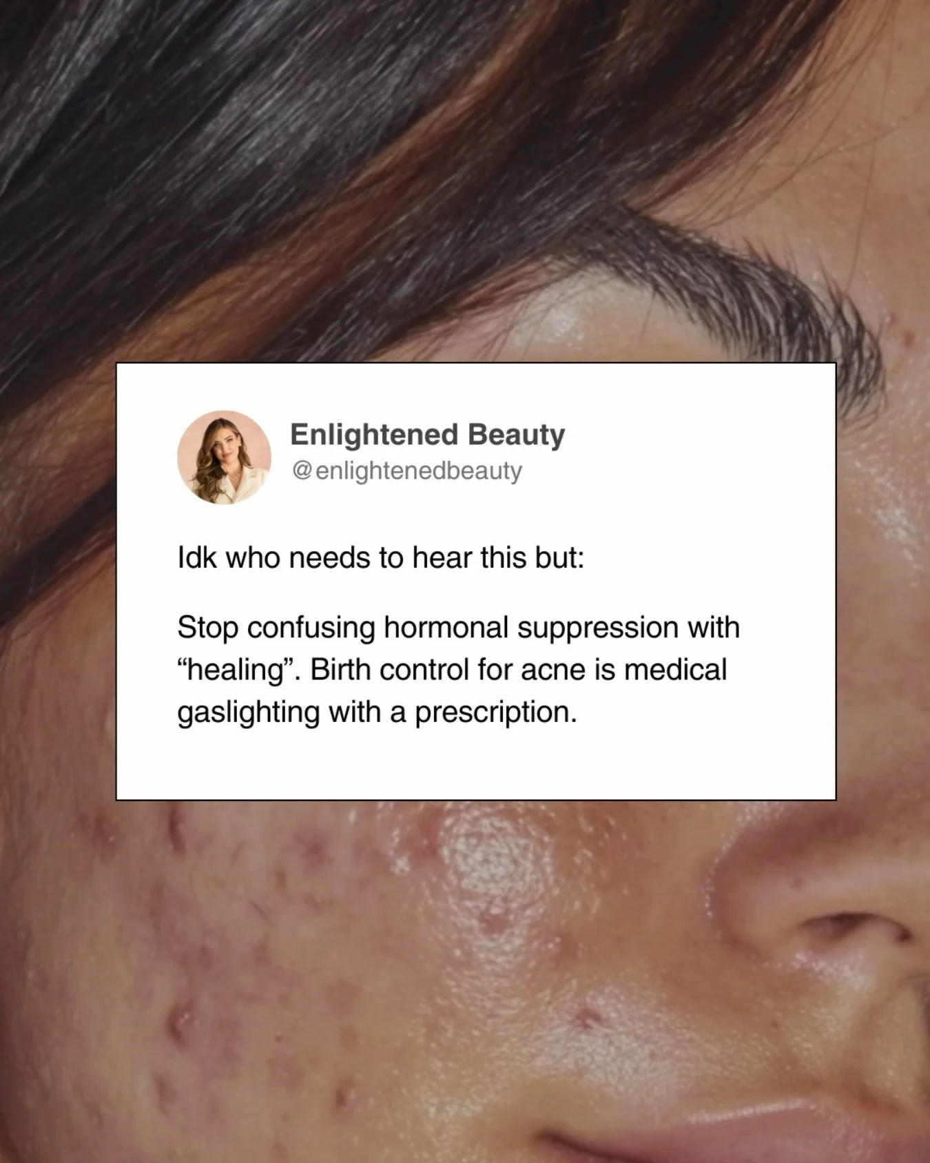 I said it with my chest 😮&zwj;💨

I&rsquo;ve talked about this before, but it bears repeating: birth control is not a treatment plan for acne. It&rsquo;s a hormonal suppressant that masks symptoms while creating new problems beneath the surface.

Th