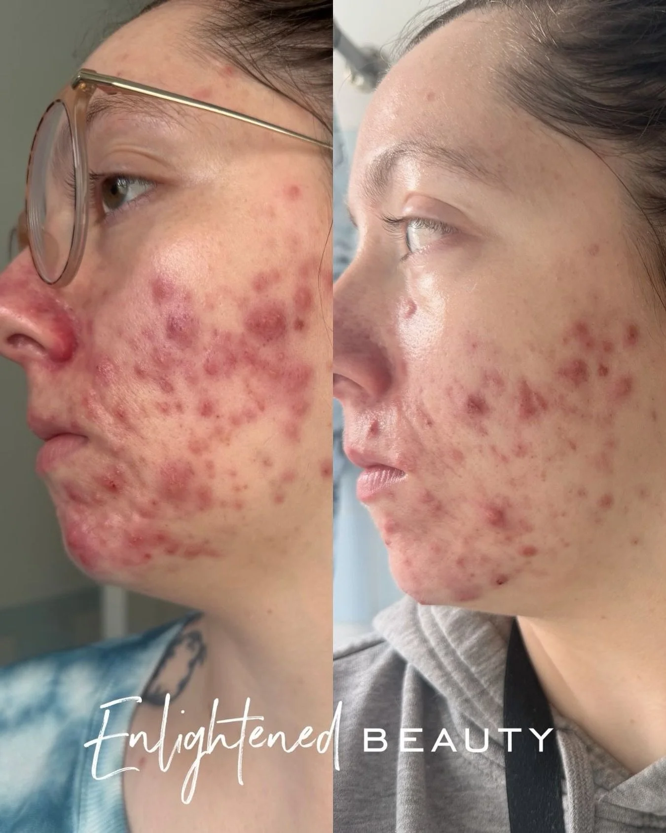7 DAYS. HOME CARE ONLY. 🤯✨
No treatments. No in-person visits.
Virtual client in NYC 🗽 &mdash; she has NEVER stepped foot in my shop.

This is what happens when your routine actually fits YOUR skin. 🔥

Not more products.
Not random trends.
Not gue