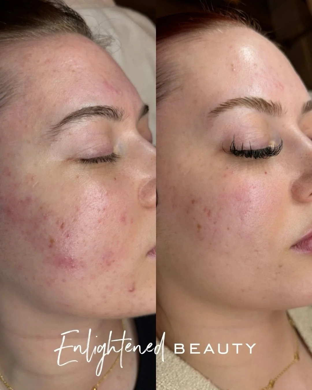 There are certain moments in this industry where you can just feel something shifting&hellip; and this is one of them ✨

This client started with me on January 3rd. We decided to go all in on the new Lira Clinical PDRN serum + Lira home care + starte