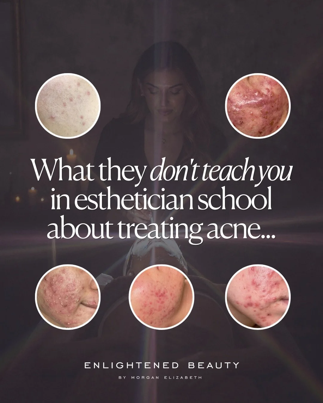 What esthetician school doesn&rsquo;t teach you about treating acne 👇🏼
⠀⠀⠀⠀⠀⠀⠀⠀⠀
If you&rsquo;ve ever replayed a treatment in your head wondering what you missed, this one&rsquo;s for you. 
⠀⠀⠀⠀⠀⠀⠀⠀⠀
Same protocol, same products, and the skin still