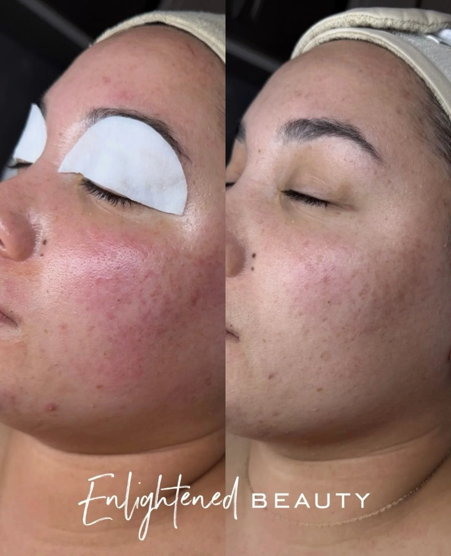 The EB effect ✨

Less redness. Less inflammation. More calm skin.

This is what happens when you stop treating your skin like it&rsquo;s the enemy.

When she first came in, her skin was inflamed, reactive, and honestly just doing the most&hellip; not