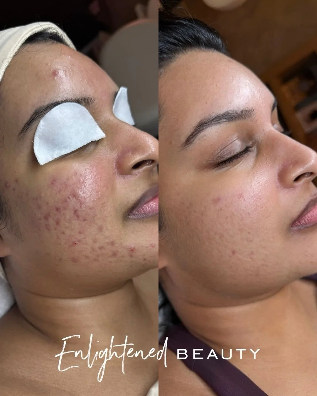 this is what one year of dedication looks like 🤍

i&rsquo;m so grateful for clients like her who trust the process, stay consistent, and really do the work&hellip; because look at her skin now. so bright, so hydrated, so much calmer 😍

this didn&rs