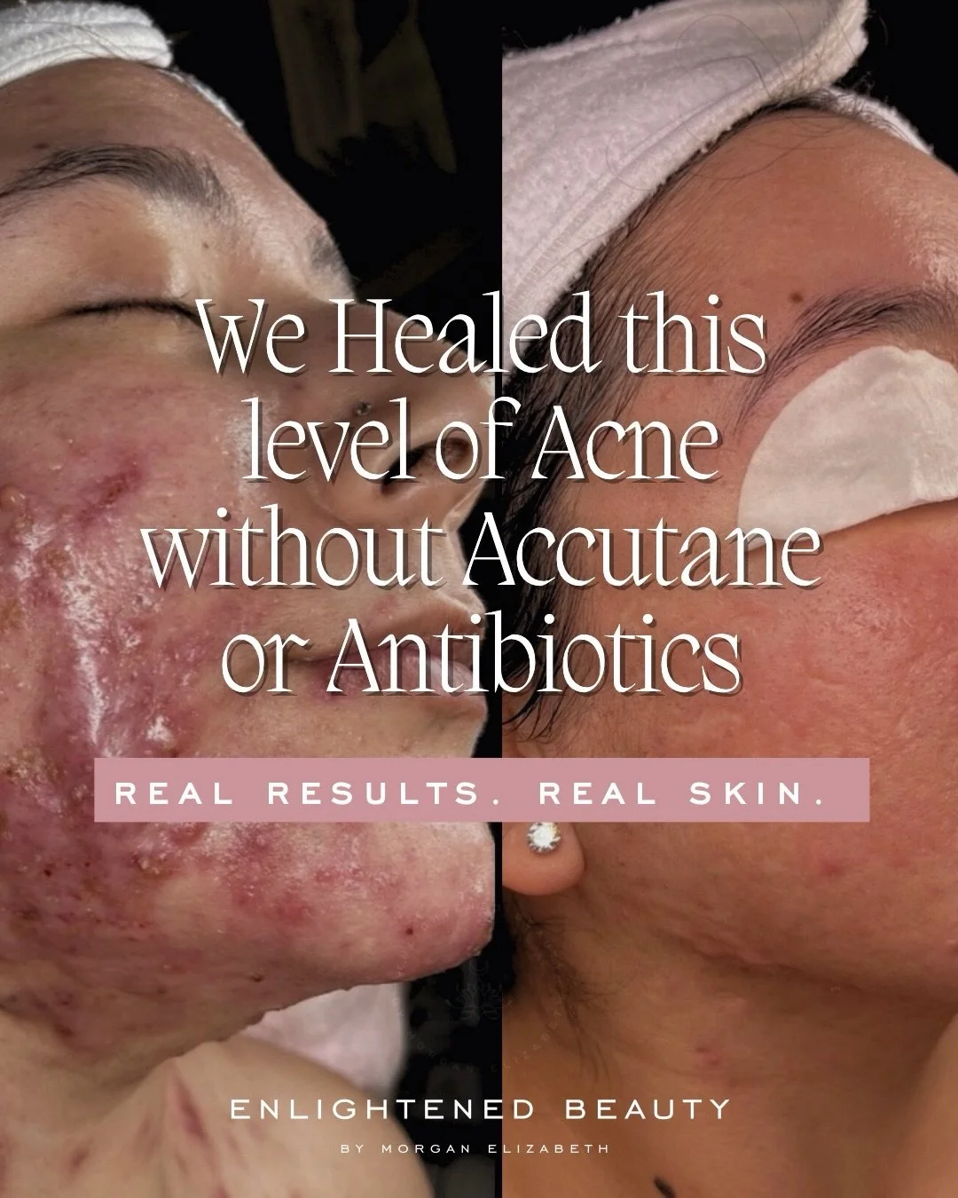 This is Emely 🤍

When she first came to me, her skin was painful.
Not just breakouts&hellip; but deep inflammation, sensitivity, and a barrier that was completely compromised.

She had already tried everything. All the products. All the trends. All 