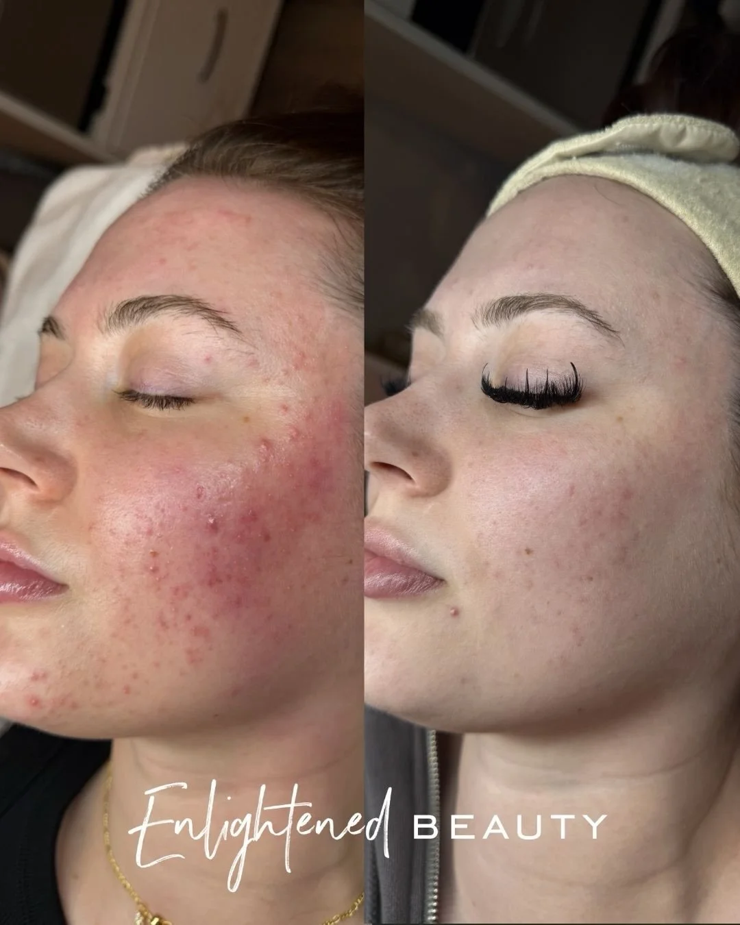 JAN - APRIL 🔥✨

Our girl is on a full Lira regimen using their brand new PDRN serum! ✨  We also started a treatment plan in March using their new PDRN booster + peels &amp; the barrier repair of this booster will be your favorite too! 🤩

Your dream