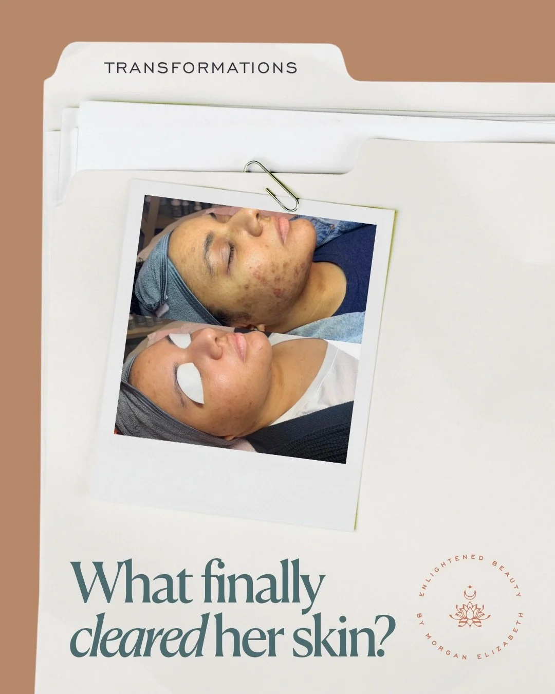 Amanda&rsquo;s transformation is one of the ones that stays with me...swipe through to see her full journey 🤍
⠀⠀⠀⠀⠀⠀⠀⠀⠀
She came in during the pandemic, overwhelmed, frustrated, and honestly exhausted from trying to figure out her skin on her own. H