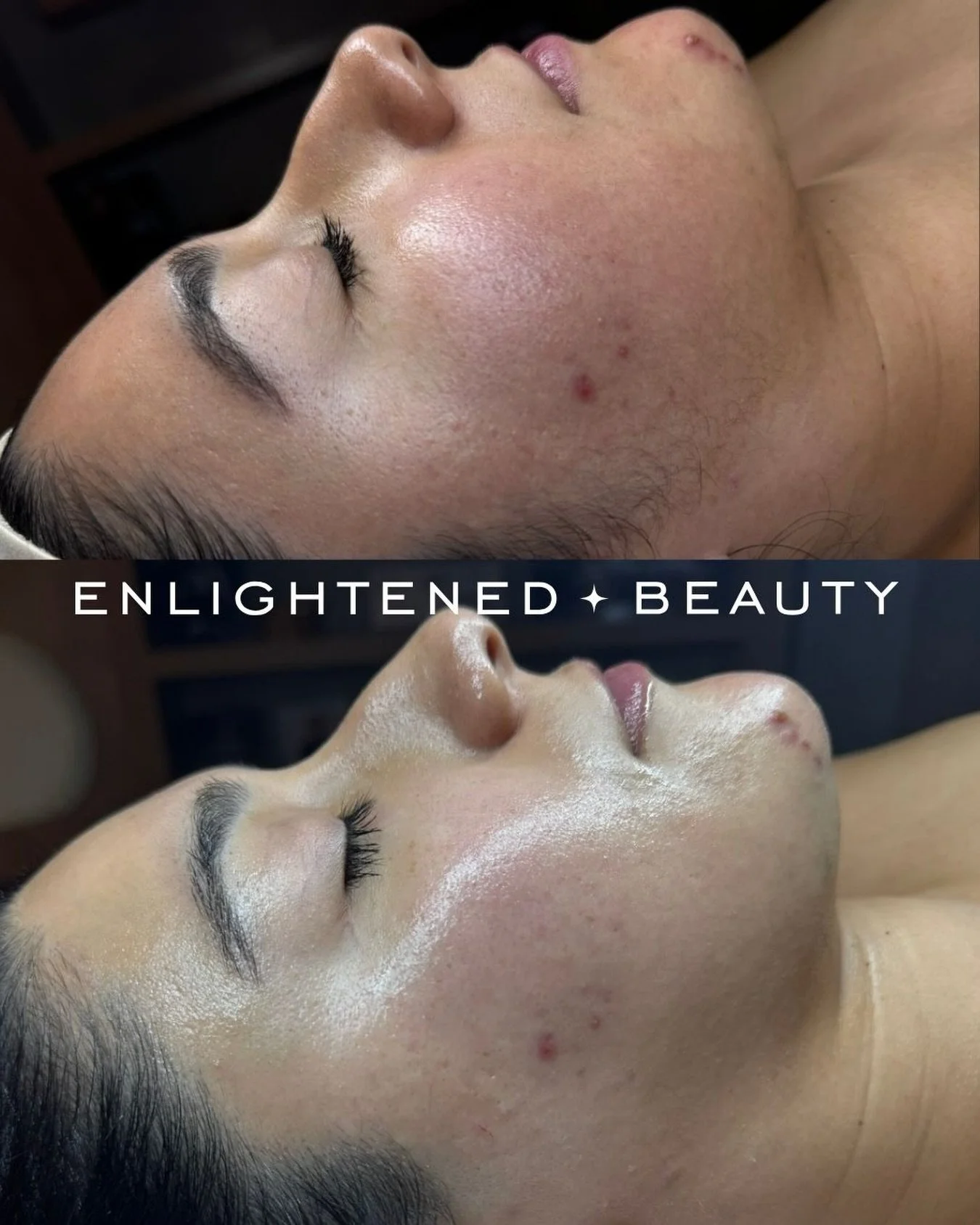 The immediate glow after a dermaplane treatment is just different ✨

Instantly smoother skin, softer texture, better product penetration, flawless makeup application, and that lit-from-within glow everyone wants 💛

Dermaplaning gently removes dead s