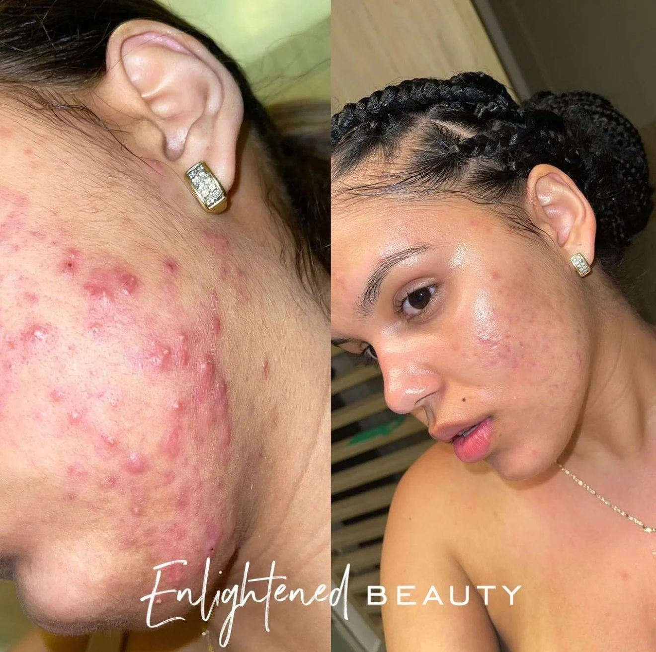 People will swear this kind of transformation only happens with medication, Accutane, or prescriptions&hellip; but that&rsquo;s simply not true. ✨ This is a virtual client who never walked into Enlightened Beauty. 

This client committed to consisten