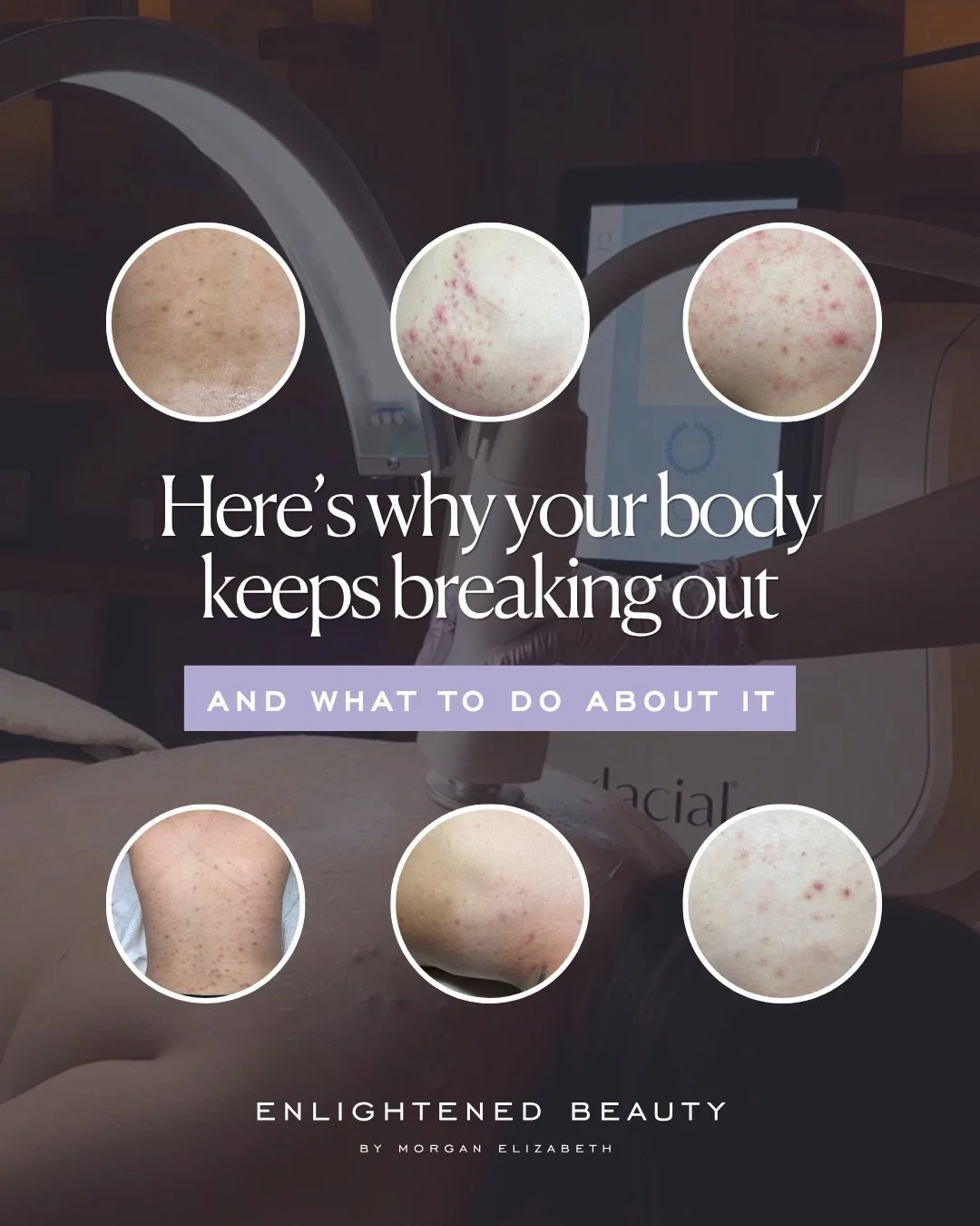 June is Acne Awareness Month 🤍

And to be honest, body acne deserves its own conversation.

So many of you have told me you feel self-conscious about your back, chest, or shoulders, especially this time of year. 

Your back, chest, and shoulders nee