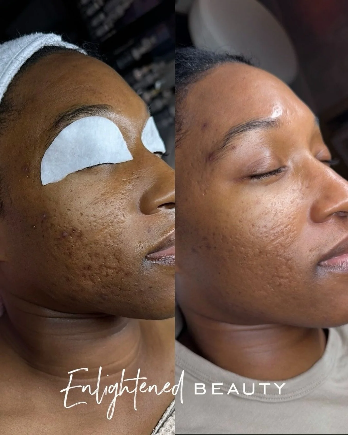 This is so special to me. ✨ 

Seeing the texture of her skin become smoother, scars appear softer, and her confidence completely bloom has been incredible to witness. 

The best part? Hearing her tell me I&rsquo;m the only esthetician she&rsquo;ll ev