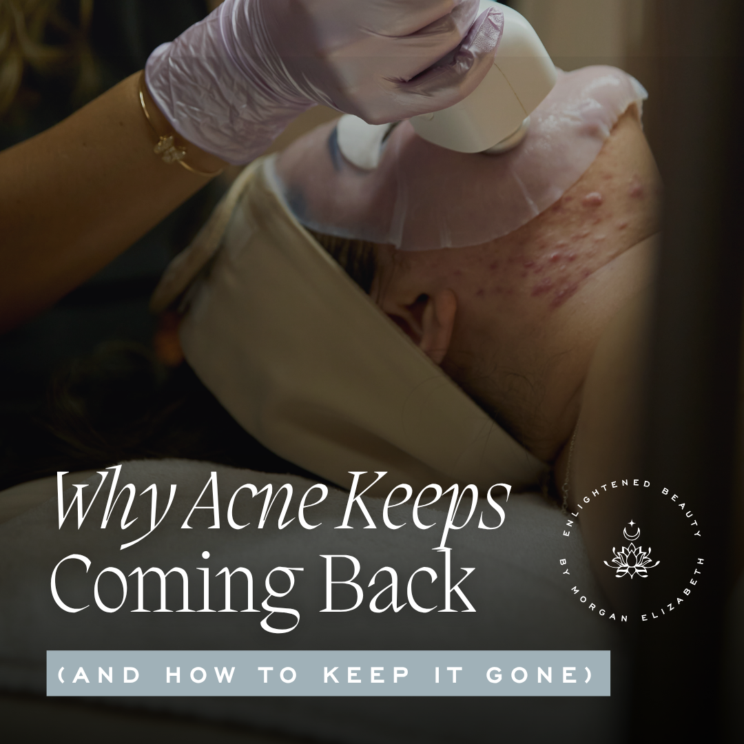 Why Does Acne Come Back After It Clears? (And How to Keep It Gone)