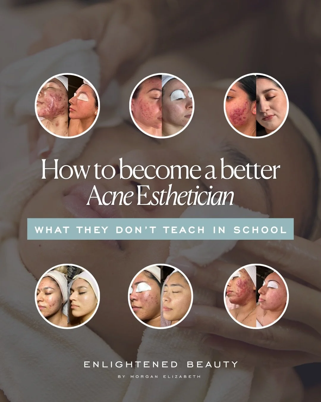 Everything that made me better at treating acne, I learned in the treatment room, one client at a time. 🤍

Comment LESSONS and I&rsquo;ll send you my deeper breakdown, including the 6 lessons I learned about acne transformations over the last decade