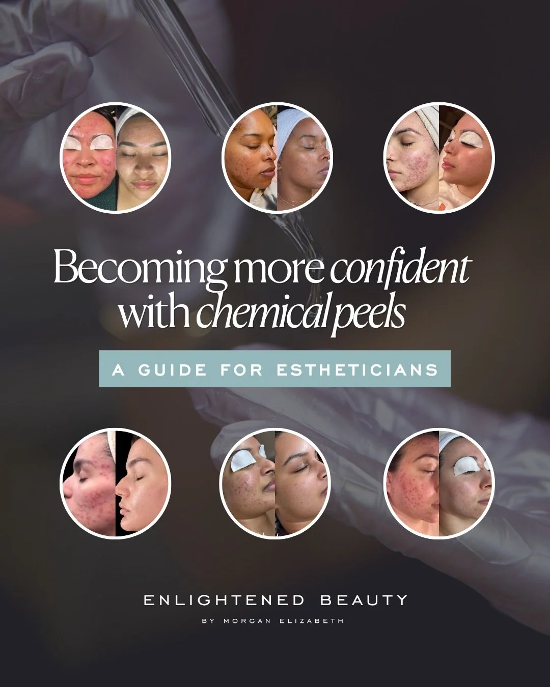 If chemical peels still make you a little nervous, good. I&rsquo;d rather you respect a peel than get too comfortable with one. 👀

I&rsquo;ve performed thousands of peels over the last decade, and I didn&rsquo;t become confident because every treatm