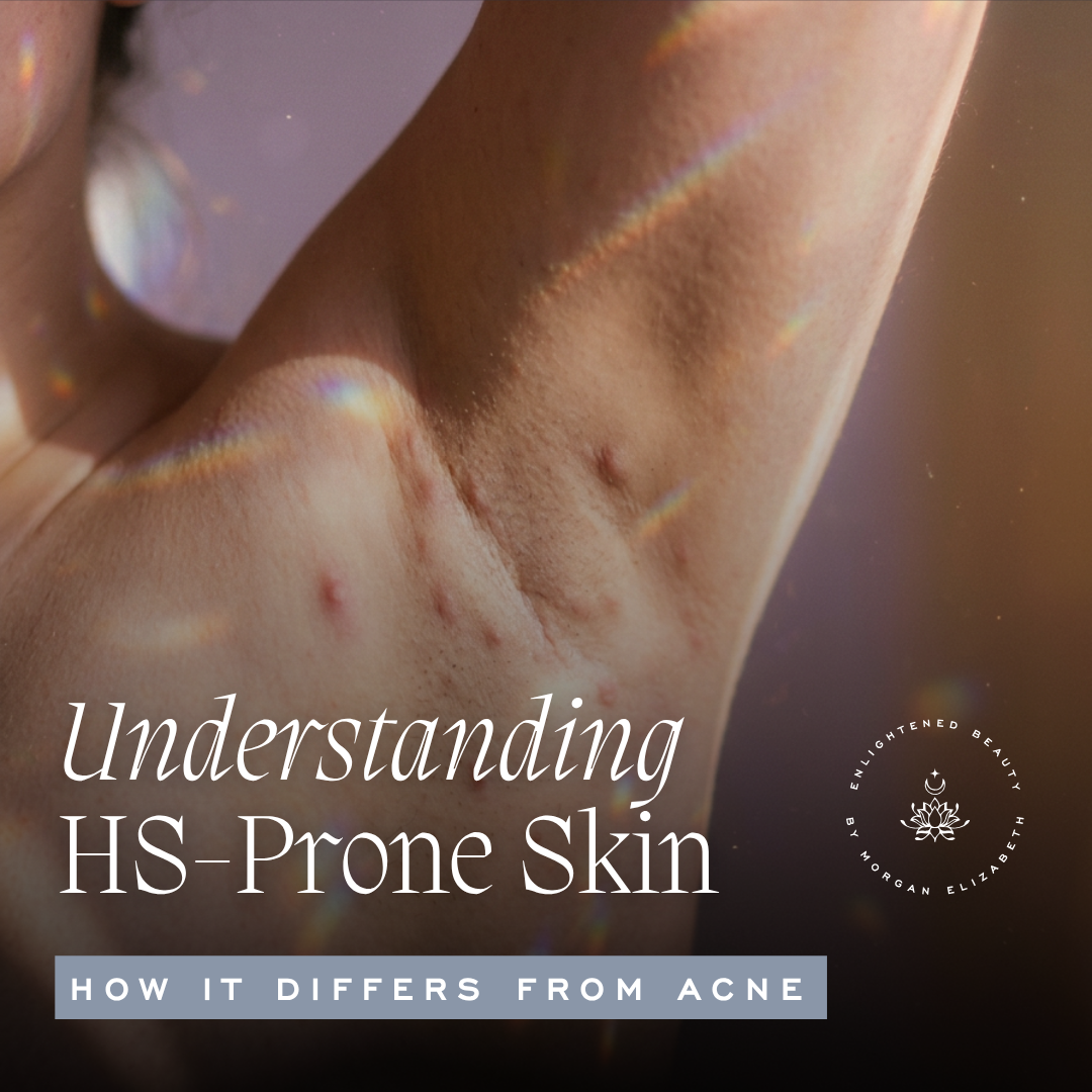 HS vs. Acne: What Hidradenitis Suppurativa Is and How to Care for HS-Prone Skin