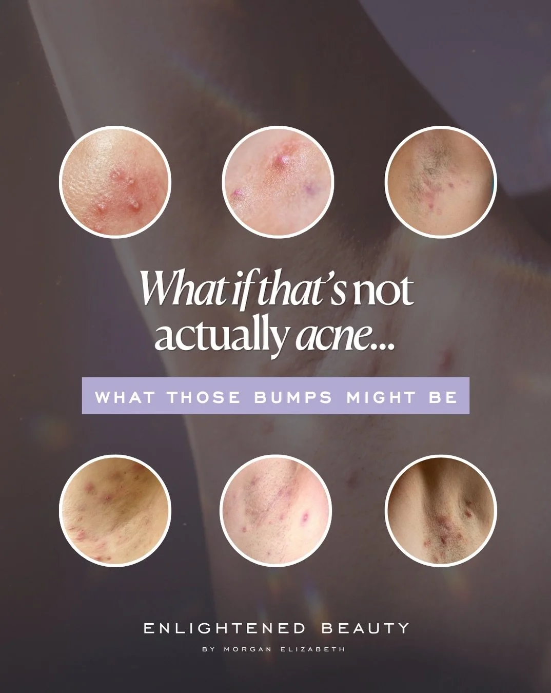 Inflammation is always a whole-body conversation for me, and HS is one of the clearest examples of why 🤍

HS (hidradenitis suppurativa) is an inflammatory condition that often gets mistaken for acne. It shows up in skin folds, sits deeper, and loves
