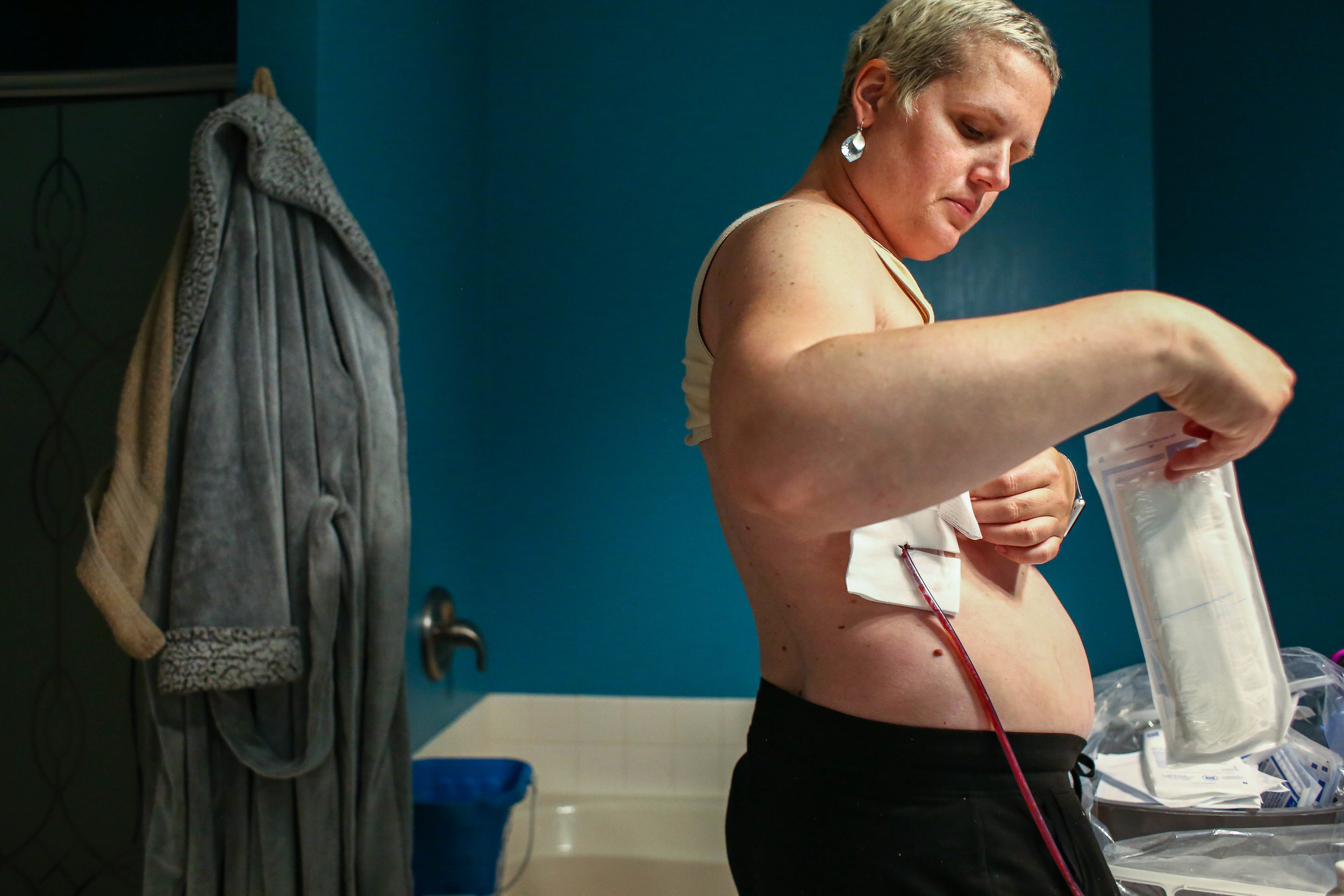 Amanda Cihak empties her surgical drains and bandages the skin area where radiation was used to treat her breast cancer every morning and night at her house, in Muskegon, Michigan on Wednesday, June 19, 2019.