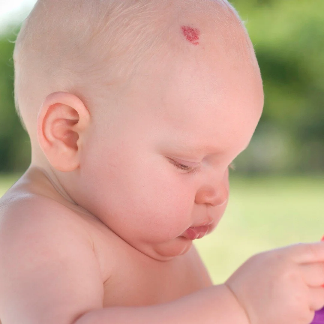 Birthmarks

There are various types of birthmarks some which fade and some which don&rsquo;t. Following is a summary of some birthmarks and what they look like.

💜 Mongolian Spots
These are blue marks that aren&rsquo;t raised and are found on lower 