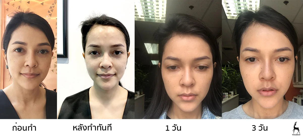 before-after คุณหญิง.jpg