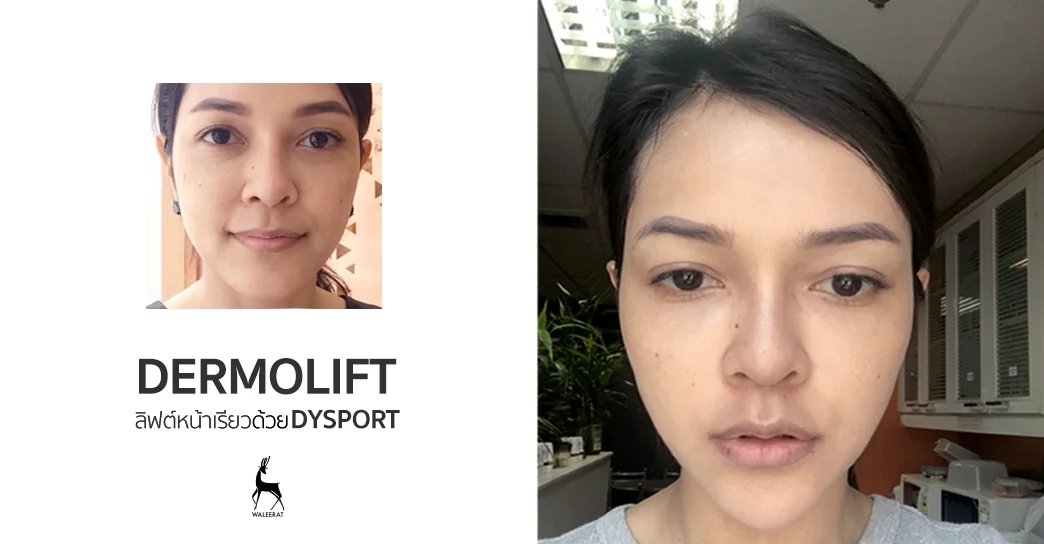 Dermolift ลิฟต์หน้าเรียวด้วย Dysport.jpg