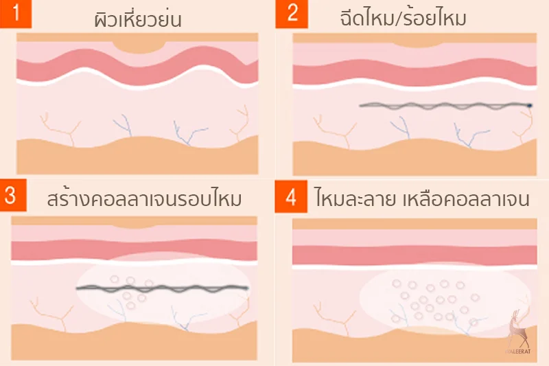 ฉีดไหมกระตุ้นคอลลาเจน.jpg