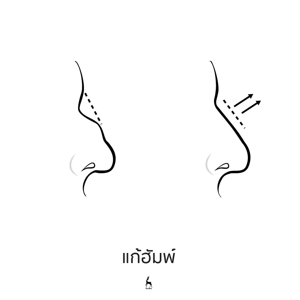 แก้ฮัมพ์.jpg