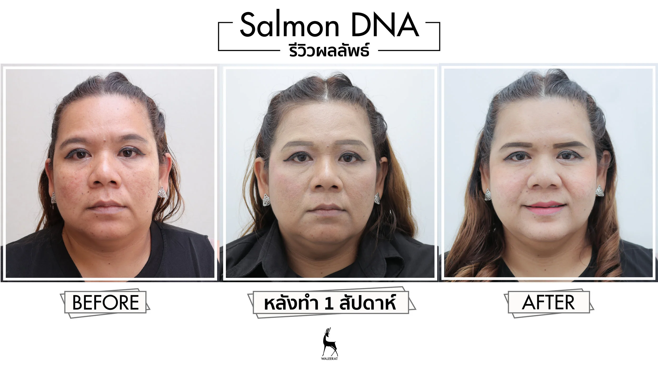 ควรรับการรักษาต่อเนื่อง สัปดาห์ละ 1 ครั้ง เป็นเวลา 3-4 ครั้ง จึงจะเห็นผลอย่างชัดเจน