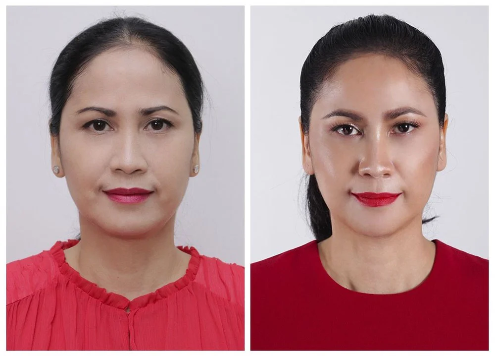 ปัญหาร่องแก้ม.jpg