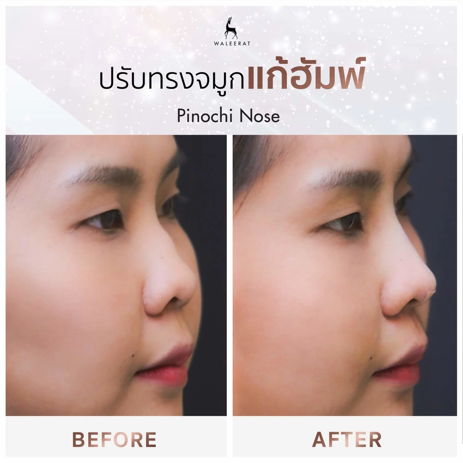 ร้อยไหมจมูก รีวิว