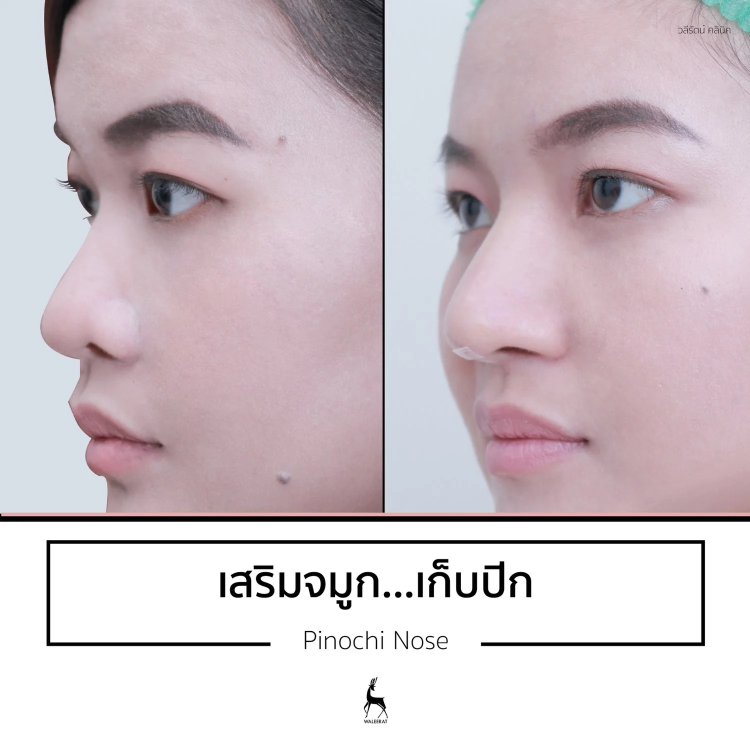ร้อยไหมจมูก รีวิว