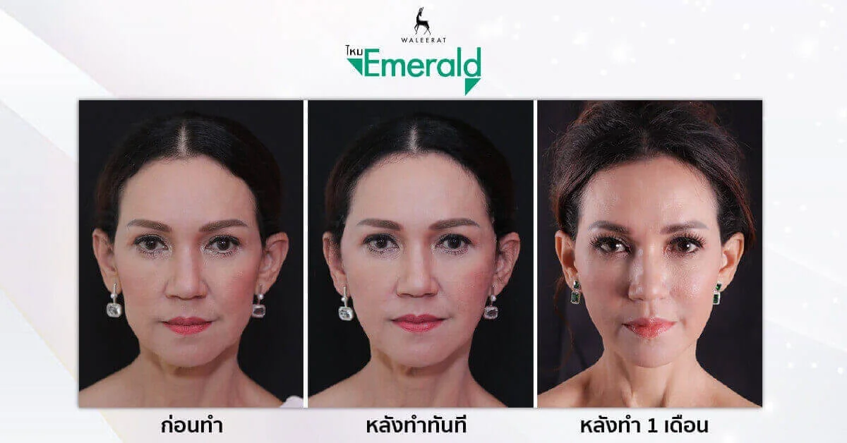 ร้อยไหม รีวิว