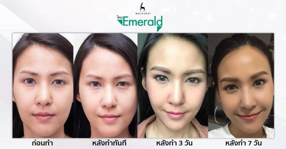ร้อยไหม รีวิว