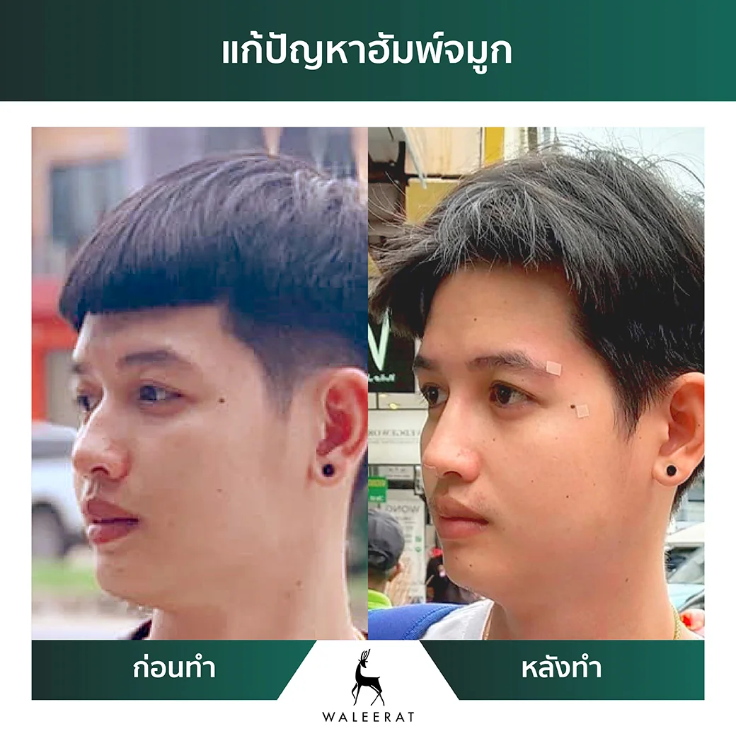 Before After_คุณใหม่