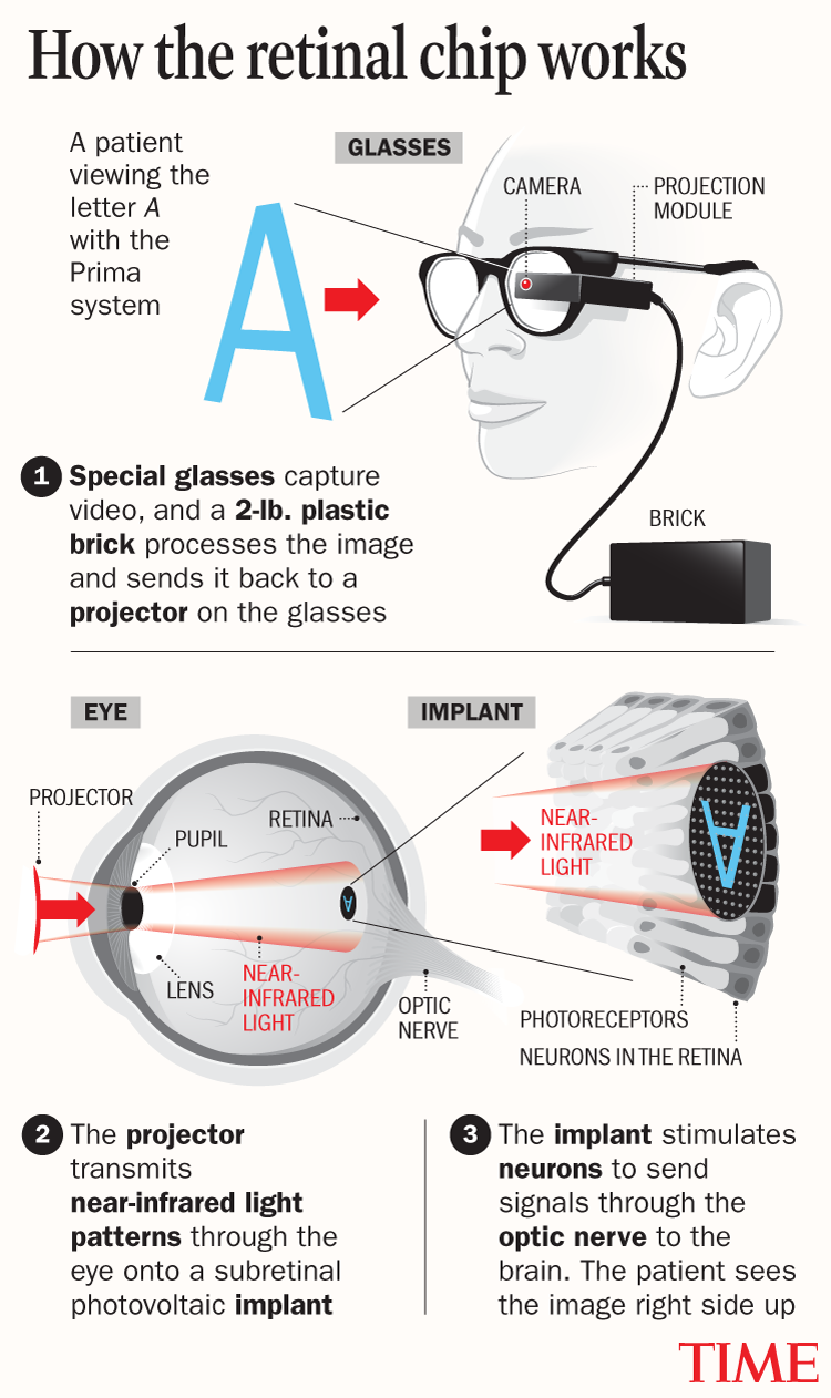 HOW THE RETINAL CHIP WORKS, 2025