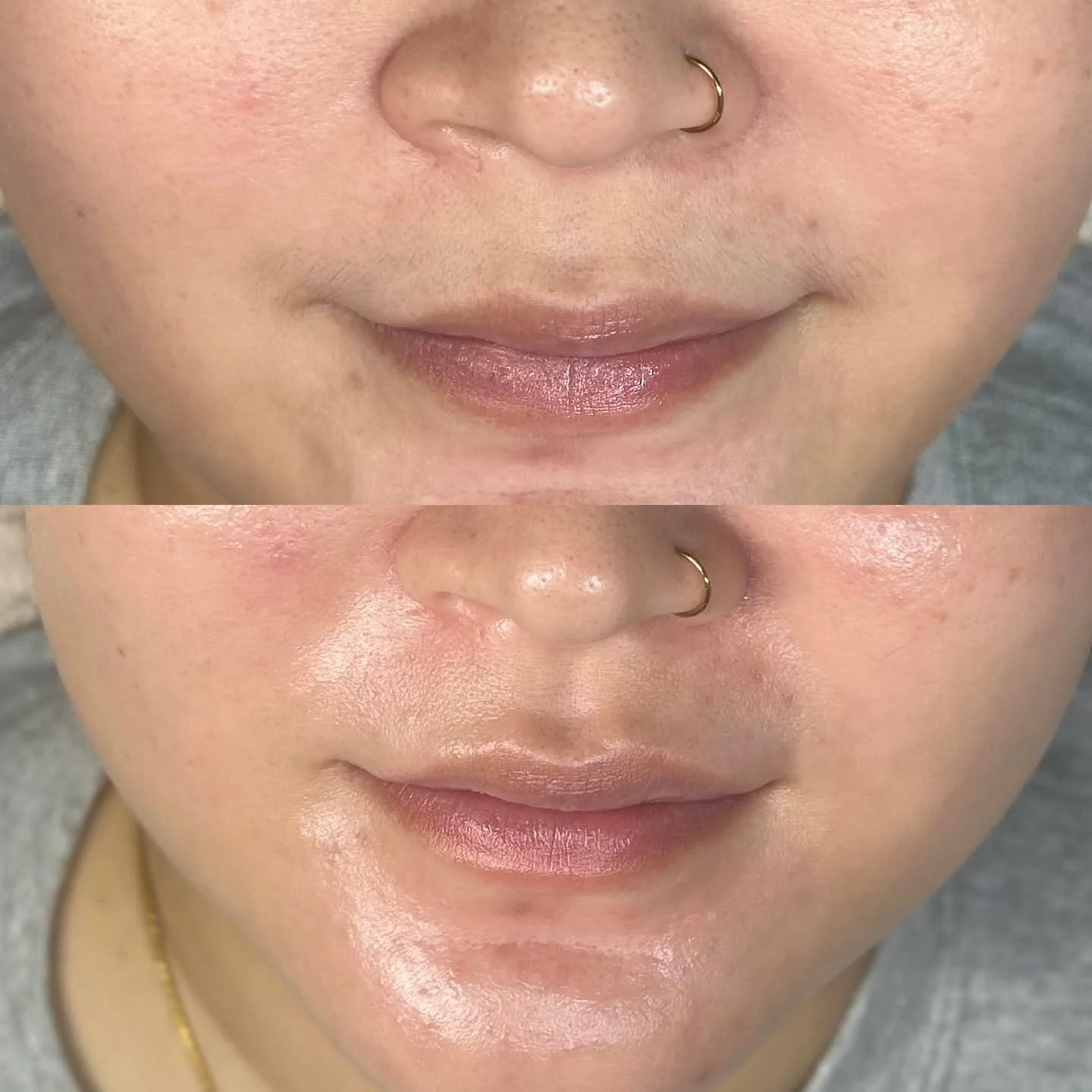 Dermaplaning by Yasmin &mdash; Before &amp; After

See the instant transformation. Dermaplaning gently removes dead skin and peach fuzz, revealing brighter, smoother, and softer skin in just one session.
Perfect for improving texture, evening out ton