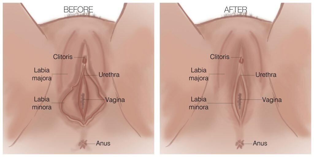 Labiaplasty-Before-and-After-Diagram-1024x512.jpg