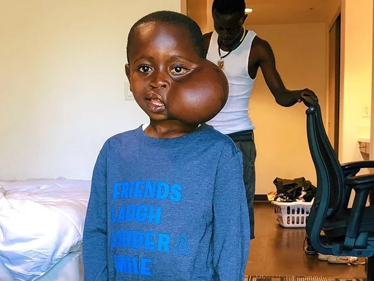 Little African boy with face tumor passes away
