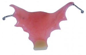 Upper-partial-denture-300x195.jpg