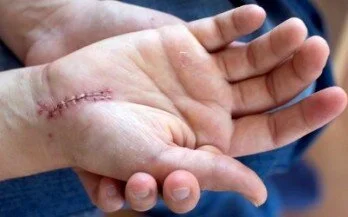 So what's the deal with "Scar Tissue" ?