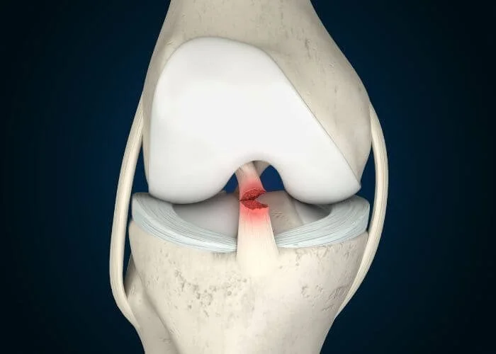 ACL Rehabilitation at Optimum Derby: Elite-Level Recovery for Lasting Results