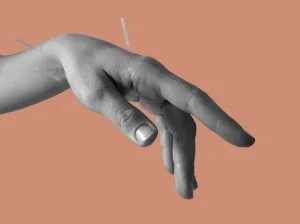 acupuncture copy.jpg